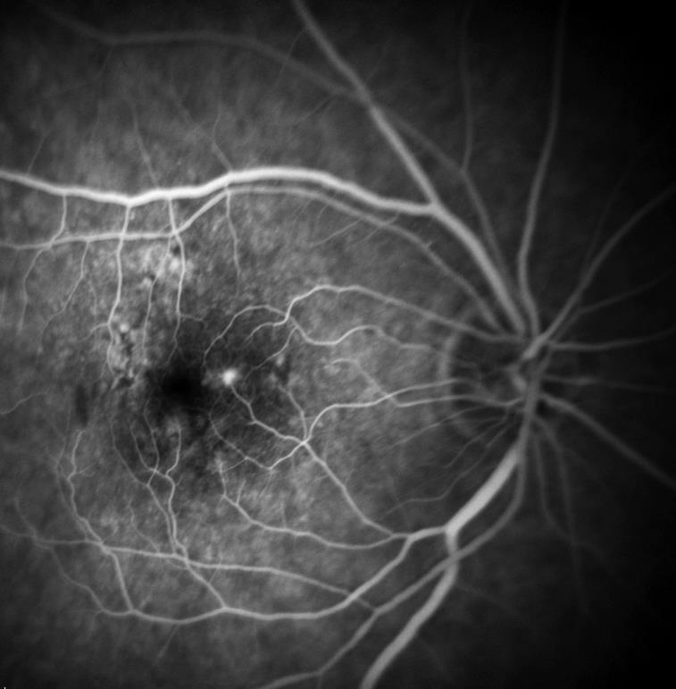 DEFINITION 1 Age-related macular degeneration (AMD) is a disorder of the macula characterized by one of the following: Presence of at least intermediate-size drusen ( 63 μm in diameter) Retinal