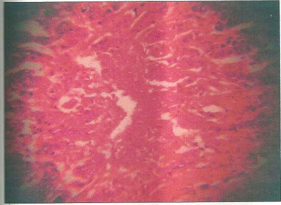 MATERIALS AND METHODS Paraffin wax embedded surgical breast tumors were obtained from the histopathology department, Jos University Teaching Hospital, Plateau State.