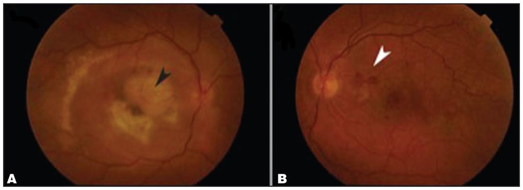Adhi et al. Page 5 Figure 1. (A) Fundus photograph of the right eye shows a large disciform scar and scarring from prior subretinal hemorrhages and laser treatments (black arrow).