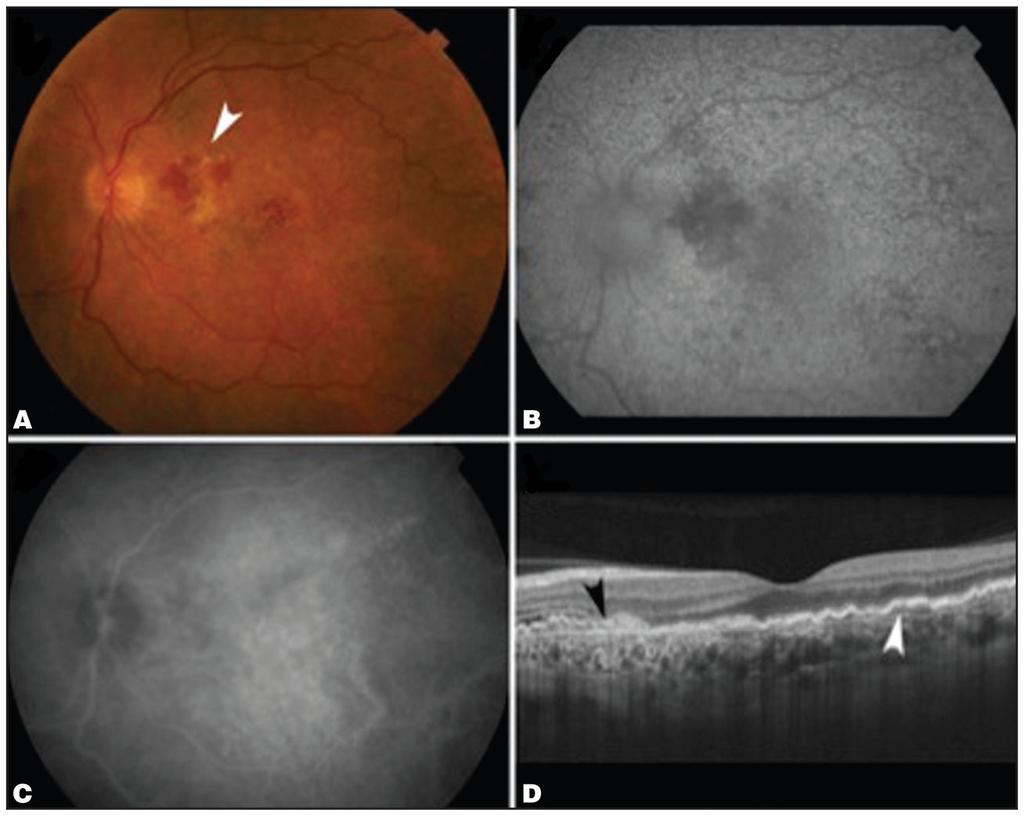 Adhi et al. Page 7 Figure 3. (A) Fundus photograph of the left eye shows chronic retinal pigment epithelium changes with new areas of extrafoveal hemorrhage and fluid (white arrow).