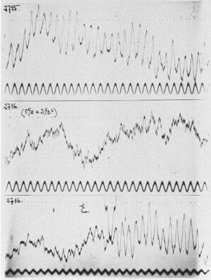 Hans Berger and the EEG The Electroencephalogram Hans Berger