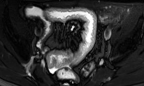 Gastroenterology 2014: MRE evaluates ulcer