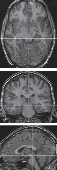 tomography (SPECT) images, respectively, of the left temporal lobe epilepsy (TLE) group. The fourth and fifth columns show the composite SISCOM and SPECT images, respectively, of the right TLE group.