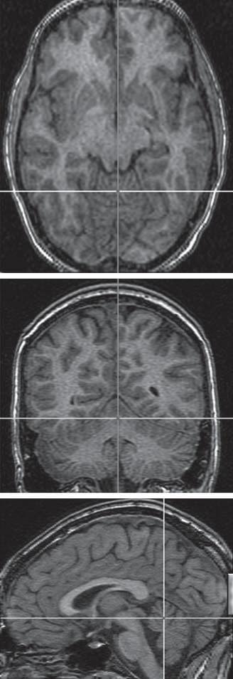 0 10 0 11 Figure 4. Hypoperfusion patterns in the right and left temporal lobe epilepsy (TLE) groups.