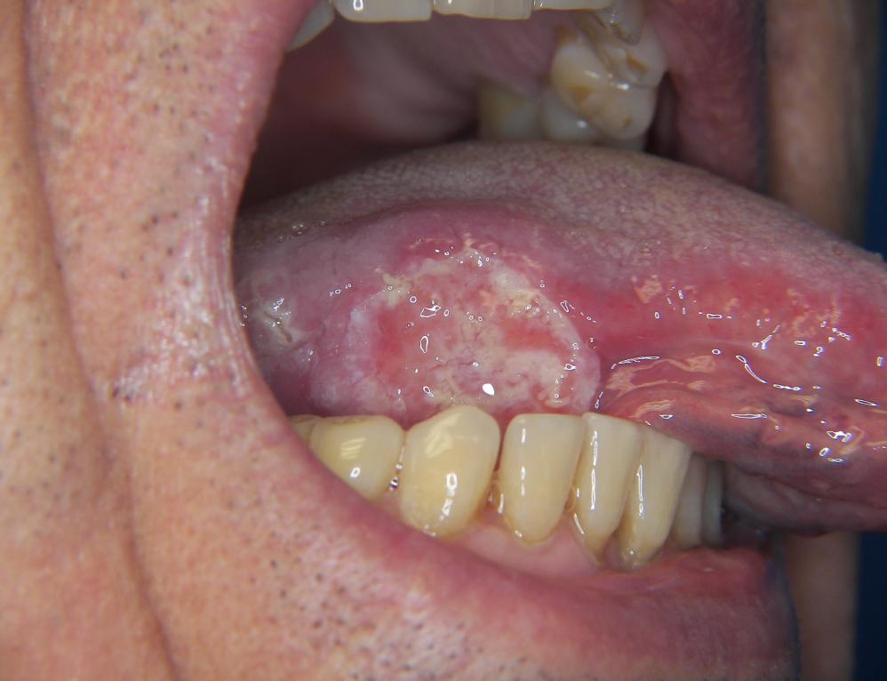 Tongue 22 to 49% of all oral cancer Anterior 2/3: 75% of cases