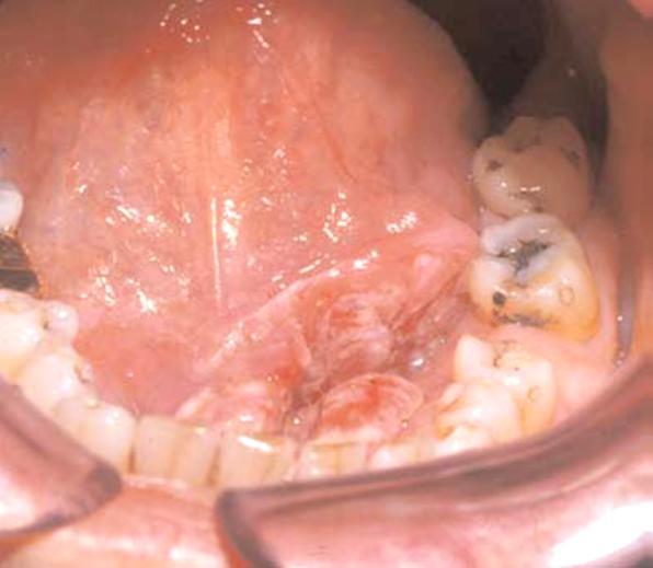 Floor of Mouth Second most common location for oral cavity SSC Resection is