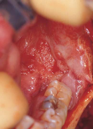 Retromolar Trigone Can resemble oropharyngeal primary cancer in behavior Larger lesions may invade the pterygomandibular space and extend towards the skull base Surgical