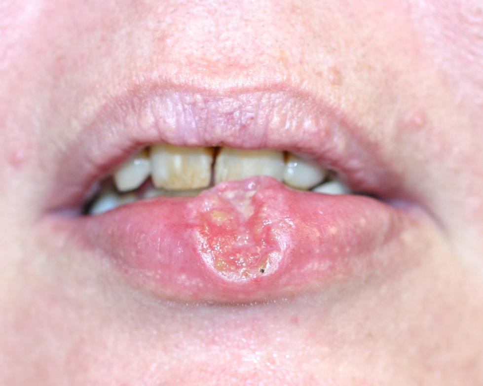 Lip Cancer Approximately 2 to 42% of oral cavity cancers.