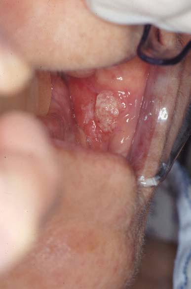 Buccal Mucosa Represents 2 to 10% of all SCC of the oral cavity Cervical lymph node metastases