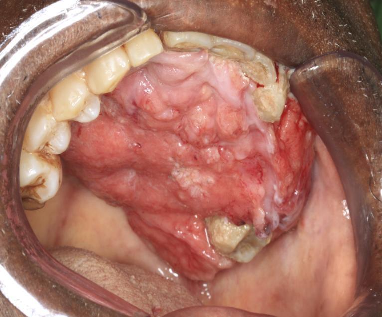 Hard Palate About 3 to 6% of all oral cavity SCC Metastasis in 10-25% of