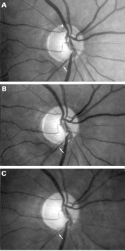 Follow up of focal narrowing of retinal arterioles in glaucoma 287 Figure 1 Optic disc photograph with progression of glaucomatous optic neuropathy.