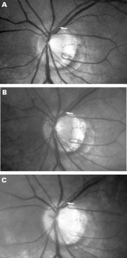 Note increase in focal thinning of retinal arteriole (white arrows); white arrowhead: disc haemorrhage.