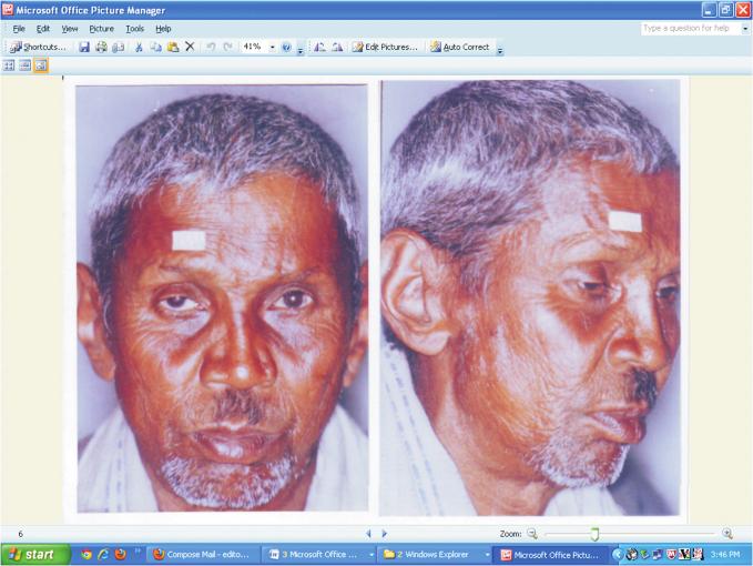 Reconstruction of moderately depressed nose in leprosy (A Long term follow-up) 1. 2. 3. 4. 5. 6. 7.