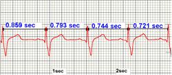 Heart Rate Variability The heart beat is not quite regular subject to small variations e.g. sinus arrhythmia Indicative of health.