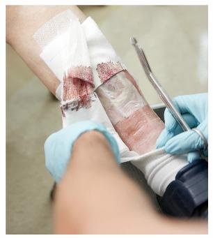 debridement ointment. Enzymatic debridement may be used after surgical debridement. This helps clean your wound more and prepare it for healing.