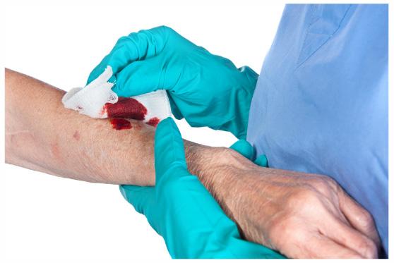 Enzymatic debridement ointments may cause redness in the skin surrounding the wound if the enzyme gets on the skin. Enzymatic debridement does not cause bleeding.
