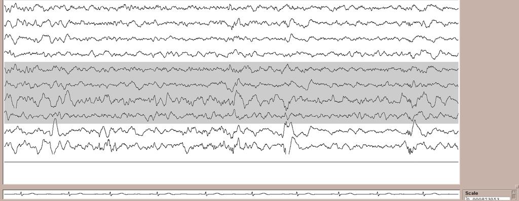 EEG: Polyspikes,