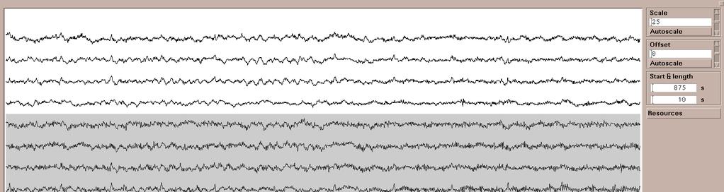 EEG: Intermittent