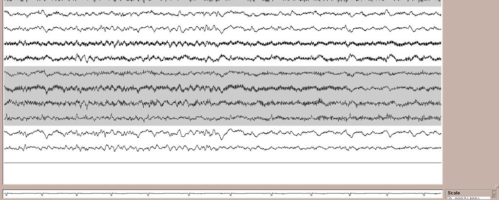 100 uv Run I EEG