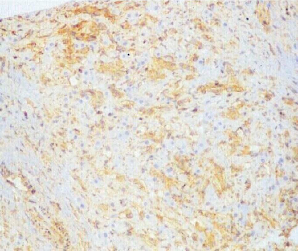 4356 GALVAO, BAKONYI, MACHADO ET AL Fig 3. Intense positively to vimentin in tumor cells (200X).