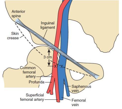 Site of Puncture Skin-Inguinal crease 2-3 cm below the mid point of the skin crease Not a realiable marker in obese patients Bony landmarks 2-3 cm below