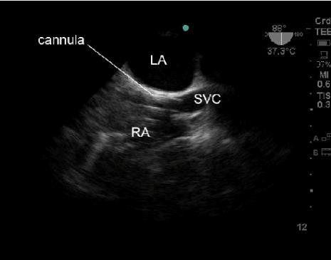 iliac artery towards the aorta. Note the modified position of the venous cannula tip compared to veno-venous ECMO.