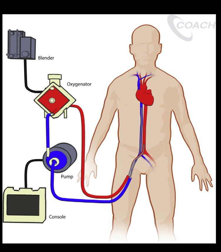 VA ECMO Circuit Cannulae (outflow/inflow) ü Tubing Centrifugal pump ü Controller ü Blender ü Heat