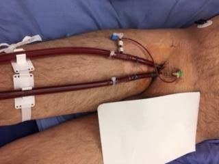 VA ECMO Femoral artery cannulation and distal leg perfusion An arterial return cannula inserted into the