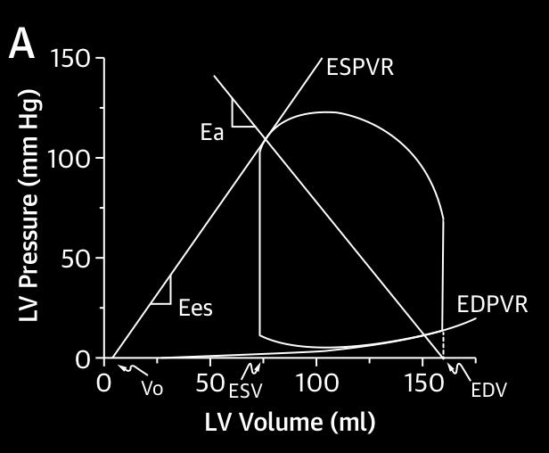 ECMO increases LV afterload A Pressure (mm Hg) 125 100 75 50 25 Baseline CGS ECMO 1.5 L/min ECMO 3.