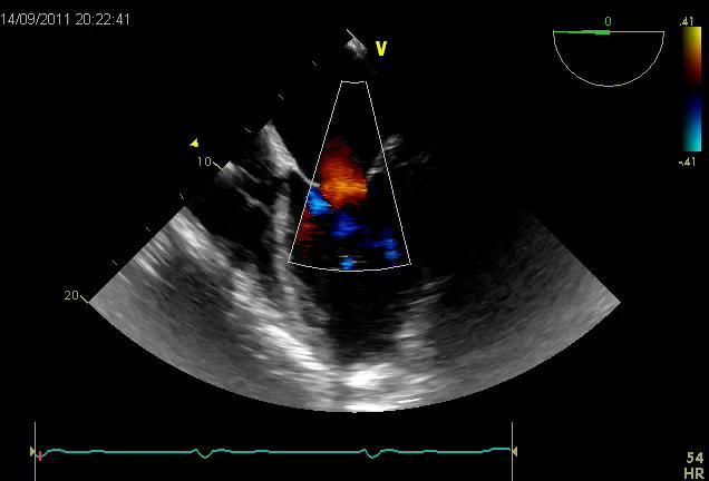 Severe Aortic