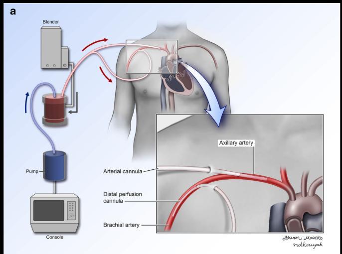 Peripheral Right Axillary Artery VA ECMO Distal perfusion cannula