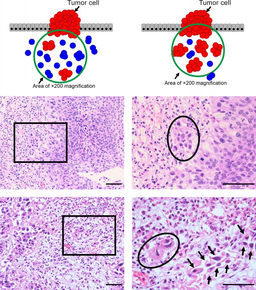 www.wileyonlinelibrary.com/journal/cas Original Article Fukumoto et al. (a) (b) (c) (d) Fig. 1. (a) Schema of positive tumor budding.