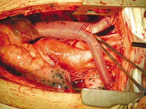 K.N. Chen: Treatment of Tumors Invading the Superior Vena Cava 167 Figure 1. Surgical procedure for patient 10.