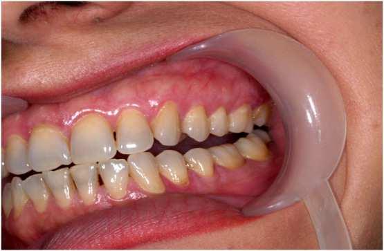 , Vučićević-Boras V, Budimir J, Brailo V. Oral lichen planus - retrospective study of 563 Croatian patients,2014, Med Oral Patol Oral Cir Bucal, 19(3), e255-60. 3. Greenberg M., Glick M.