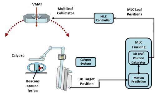 First treatment of electromagnetic-guided real-time adaptive RT using MLC