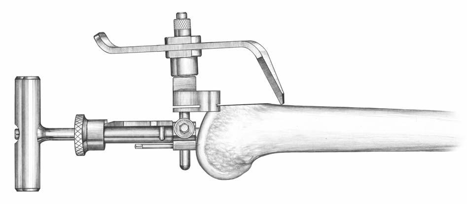 Figure 11 > Tighten the side screw with the hex wrench to lock the resection guide in place (Figure