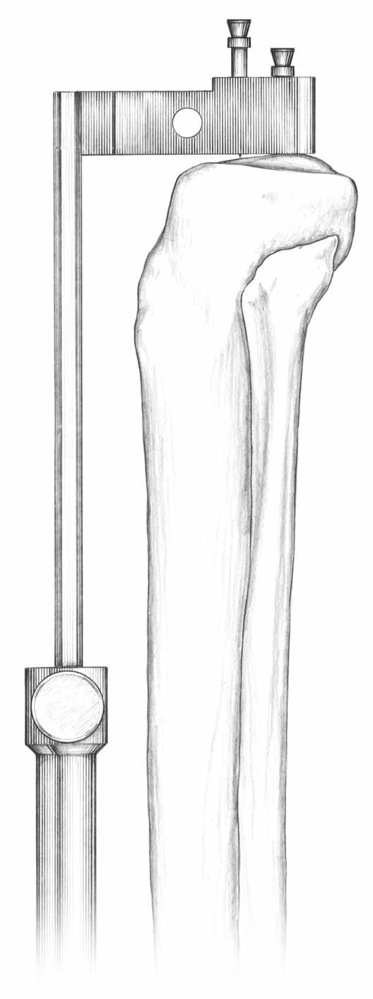 Scorpio ClassiQ Anterior Referencing Surgical Protocol Proximal Shaft Fixation Pin Tibial Tibial External Alignment > With the knee flexed, place the External Tibial Alignment Guide on the tibial