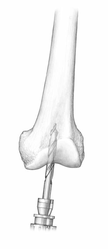 > Removal of osteophytes from the margins of the intercondylar notch may aid identification of