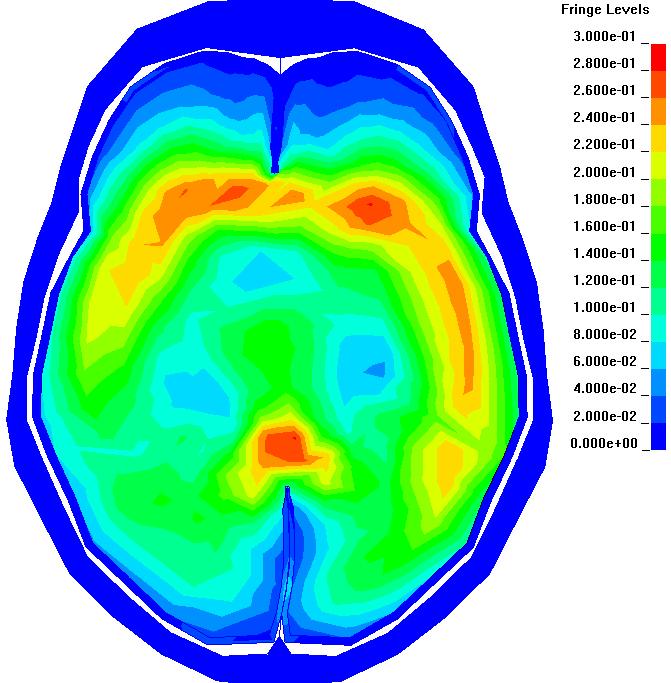 red Hematoma in the frontal lobe Hematoma