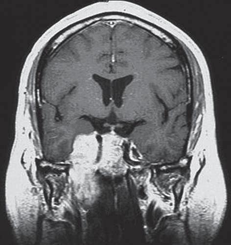 TL V3 Figure 3. Imaging findings from a 47-year-old man who presented with headache and diplopia.