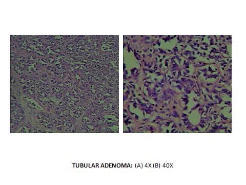 Fibroadenoma 10x shows pericanalicular (Open glandular-spaces) & intracanalicular compressed glandular spaces.