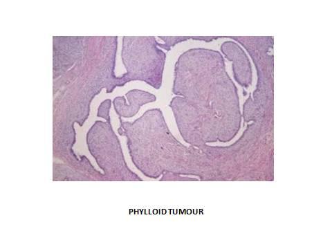 Tubular adenoma 10x & 40x shows closely packed uniform small tubules lined by single layer of epithelial cells and