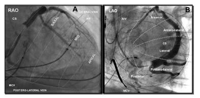Determination of LV Lead Placement by Venogram - Originally: Advance lead to distal vein, apical pacing - Increased mortality compared to basal/mid LV pacing -
