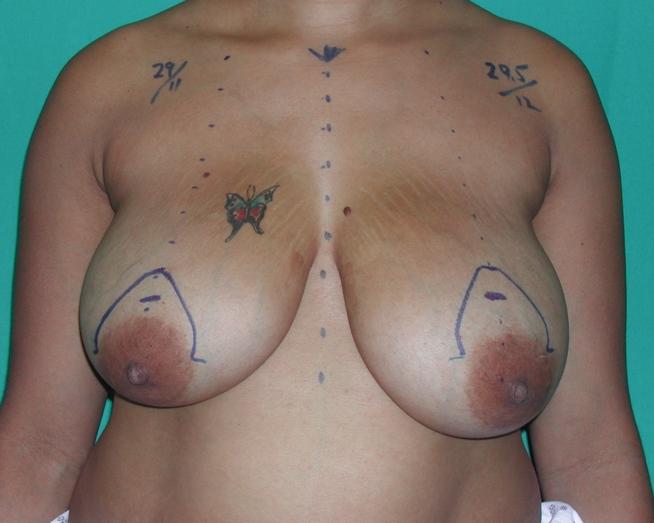 Figure 1. The top of the new areola is marked 2 cm above the new areola position, and a mosque pattern of 14 or 16 cm is drawn. Figure 3.