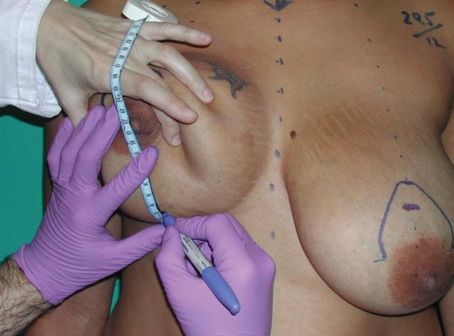 The inferior border of the skin excision is marked at the lower pole of the breast meridian. This is commonly placed between 2 and 4 cm above the inframammary fold. Figure 4.