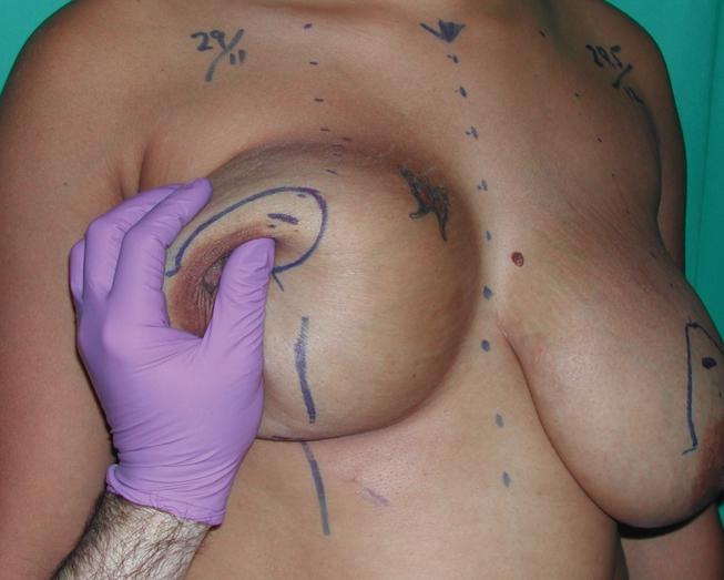 About halfway between the base of the mosque and the inferior breast skin excision marks, a vertical line is drawn to align with the breast meridian at the inframammary fold.