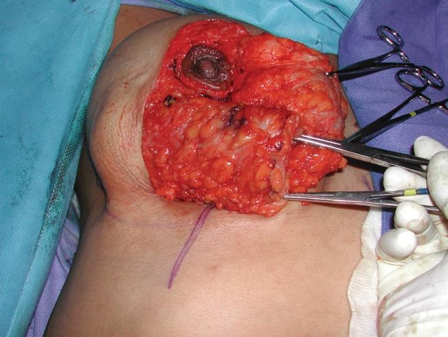Furthermore, this maneuver can potentially increase the risk of tissue necrosis, as well as potentially constrict or distort the NAC and superior pedicle when ﬁnal inset and closure are performed.