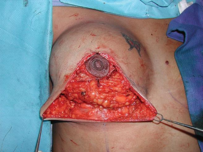 A divot at the inframammary fold is avoided (1) by making the lower incision V- shaped as opposed to U-shaped, and (2) by avoiding placing the skin suture to the chest wall.