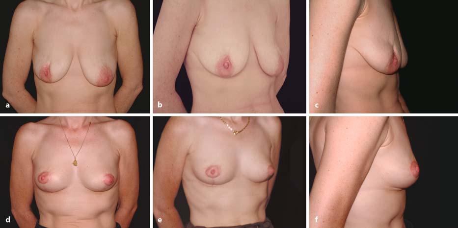120 Chapter 12 The Use of Vertical Scar Techniques Fig. 12.5. a c Preoperative views: a patient who had a conserving right breast therapy left with retroareolar defect.