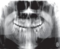 history of any systemic diseases or known syndrome. One case was found where the patient had impacted supernumerary and permanent teeth at the same time.(.